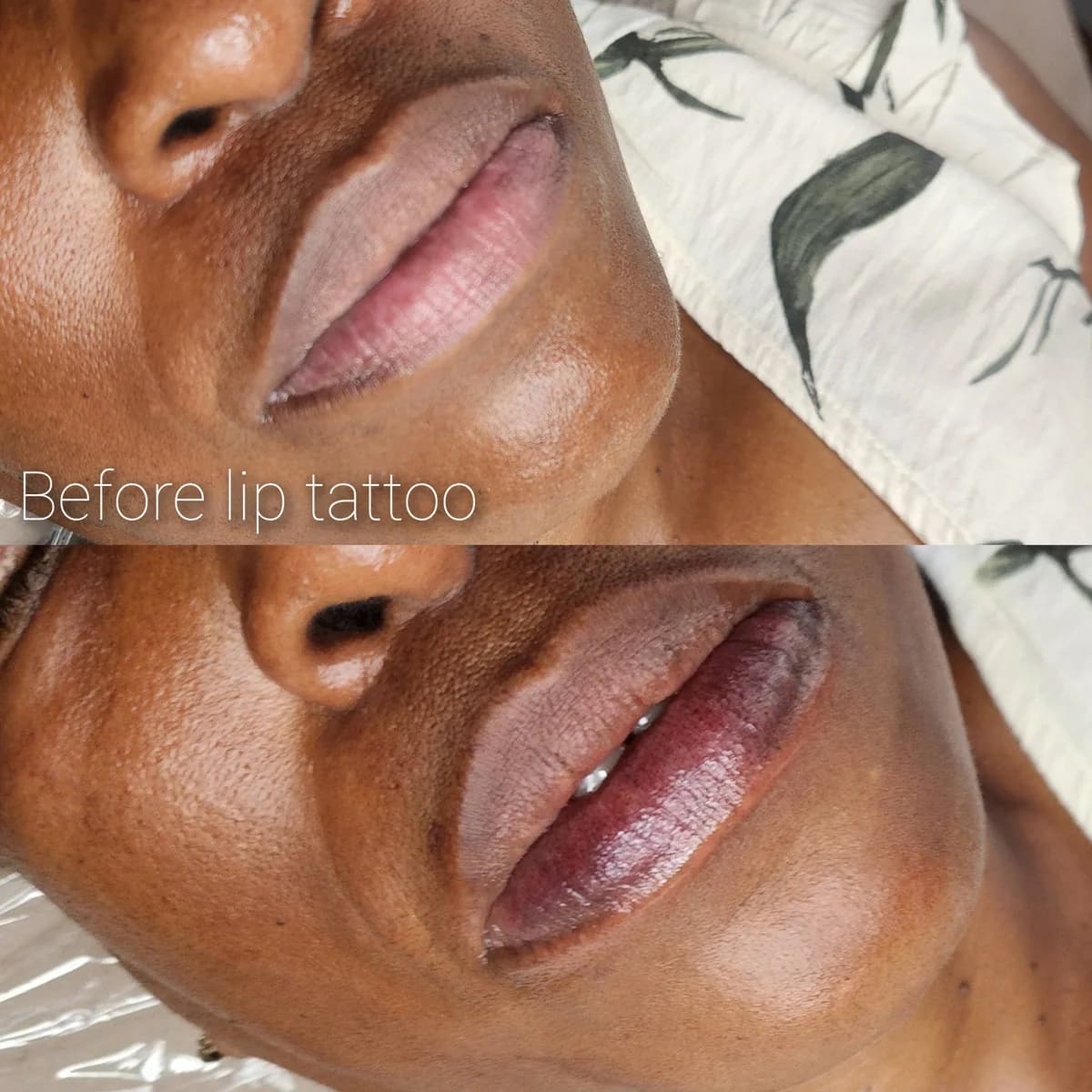 Before and after: Healed · Lip hyperpigmentation treatment