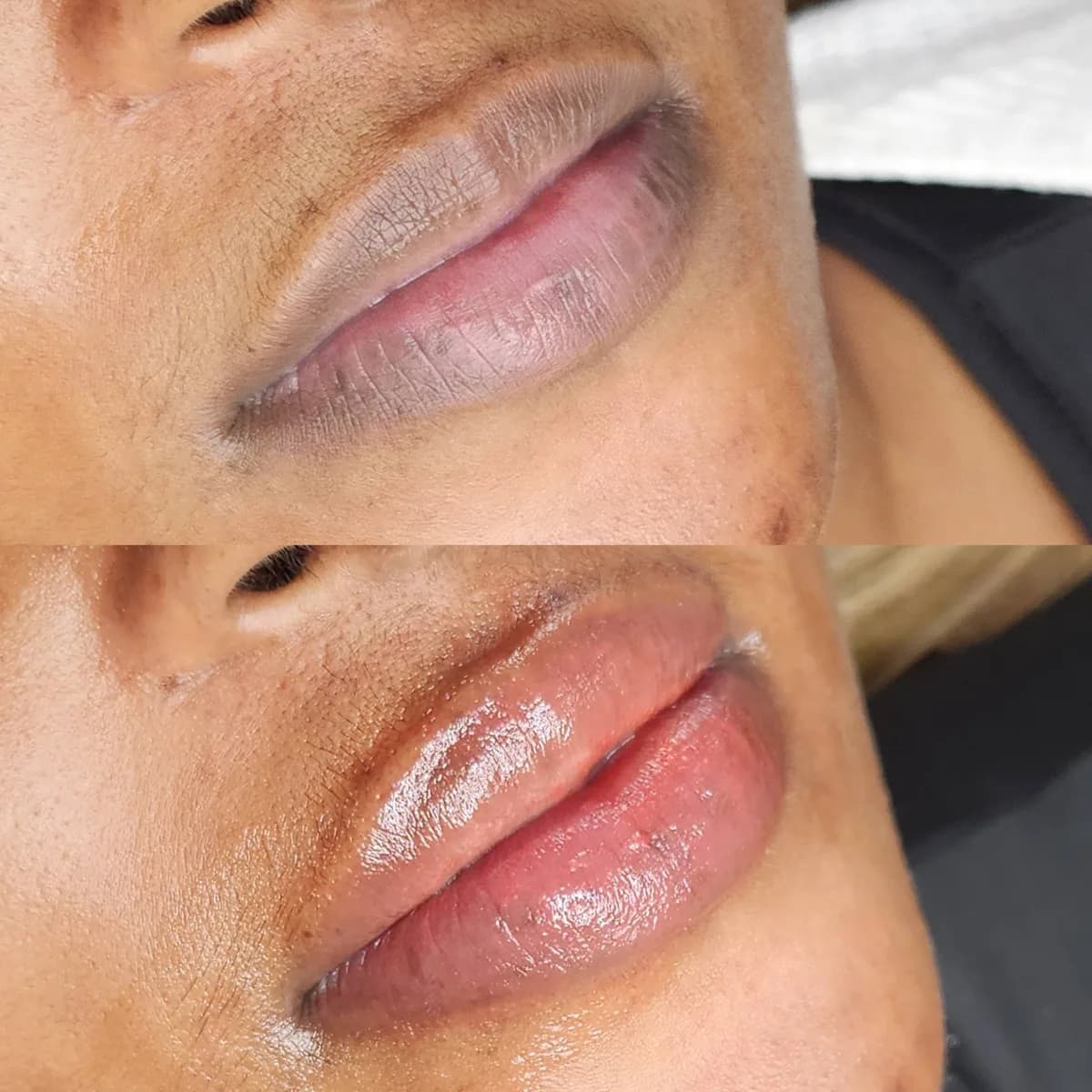 Before and after: Healed · Lip hyperpigmentation treatment