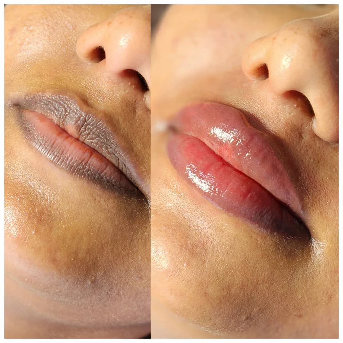 Before and after: Healed · Lip hyperpigmentation treatment