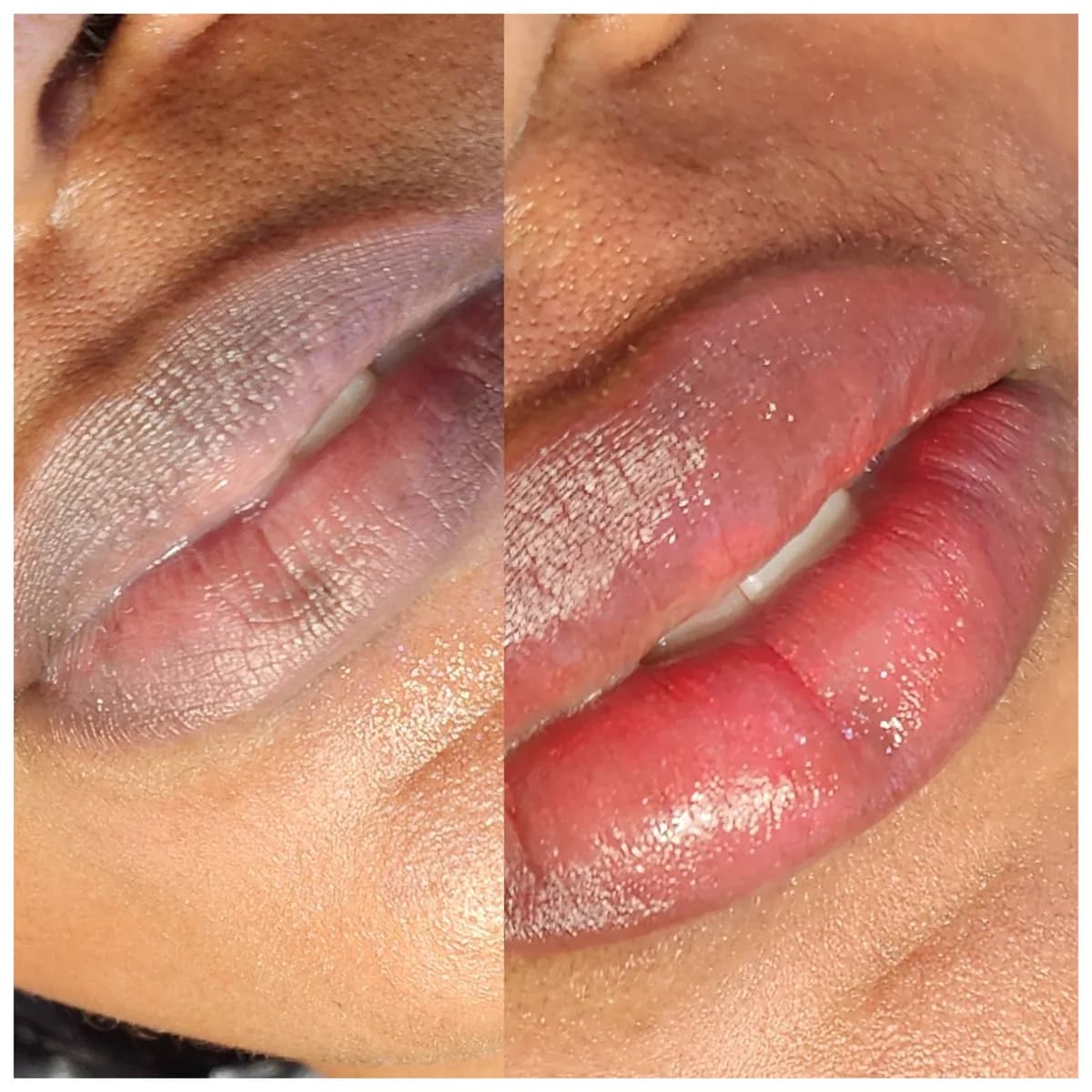 Before and after: Healed · Lip hyperpigmentation treatment
