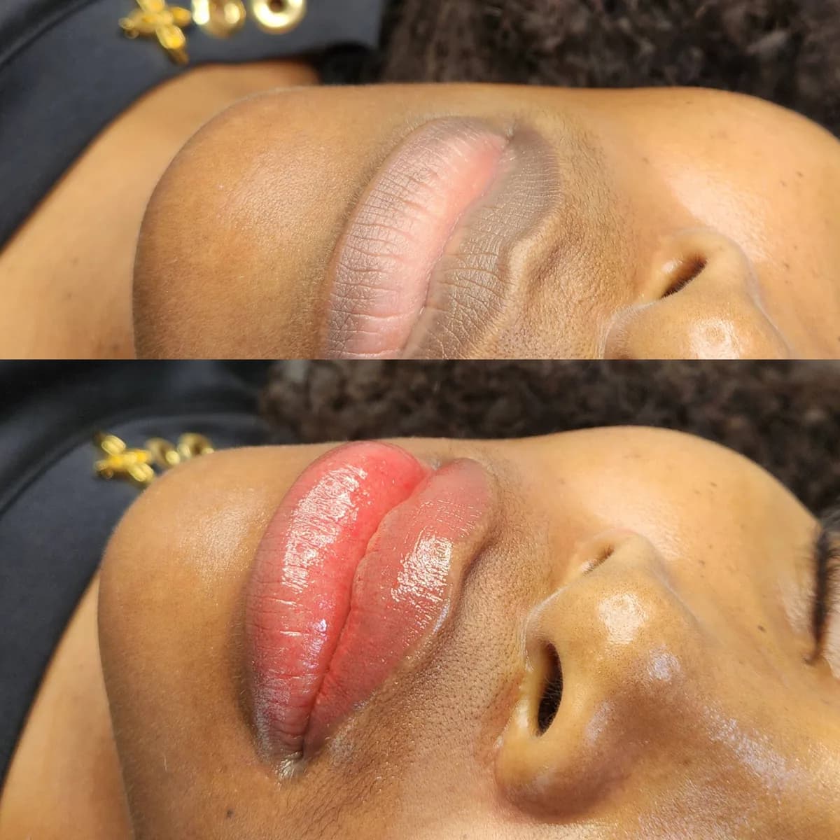 Before and after: Healed · Lip hyperpigmentation treatment