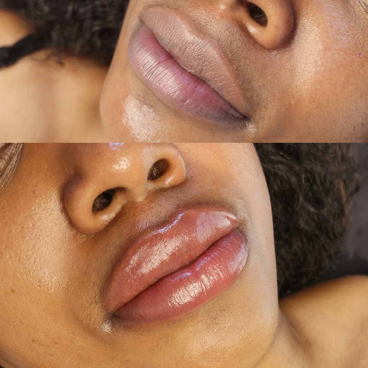 Before and after: Lip hyperpigmentation treatment