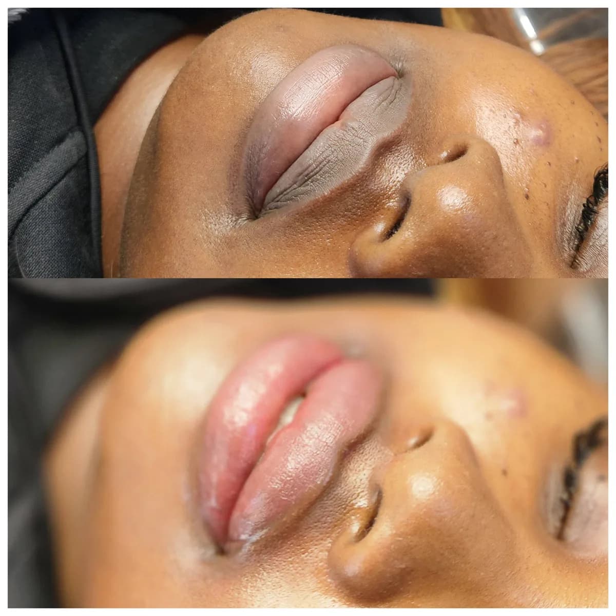 Before and after: Lip hyperpigmentation treatment