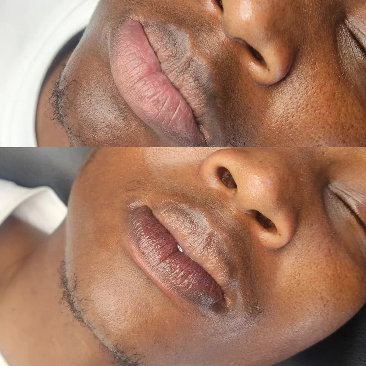 Before and after: Lip hyperpigmentation treatment