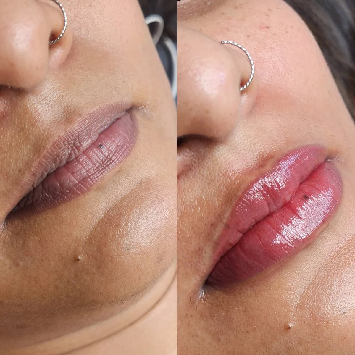 Before and after: Lip hyperpigmentation treatment