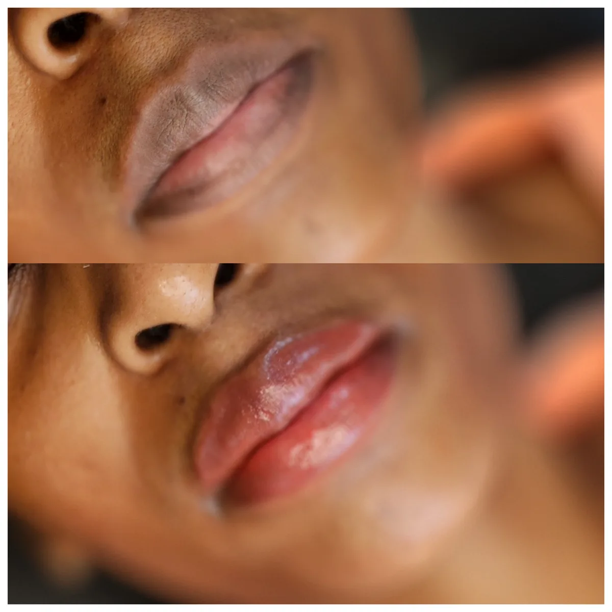 Before and after: Lip hyperpigmentation treatment