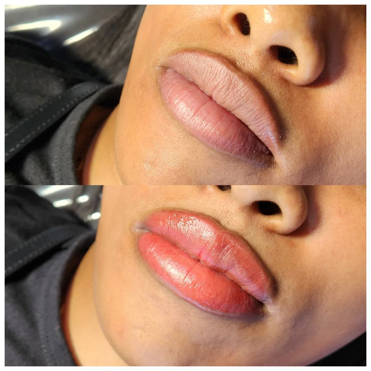 Before and after: Lip hyperpigmentation treatment