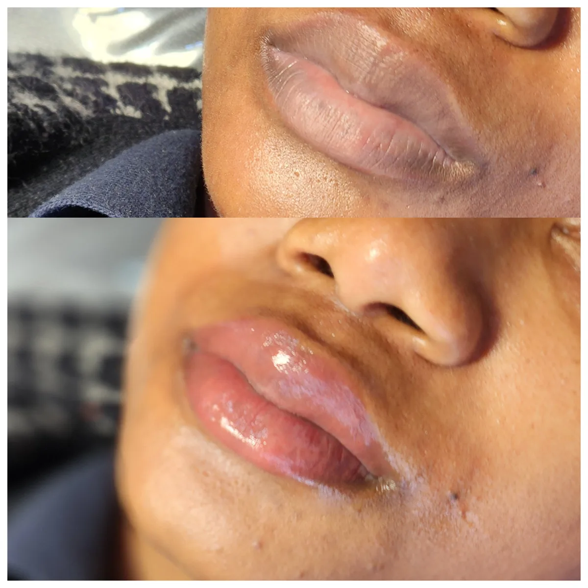 Before and after: Lip hyperpigmentation treatment