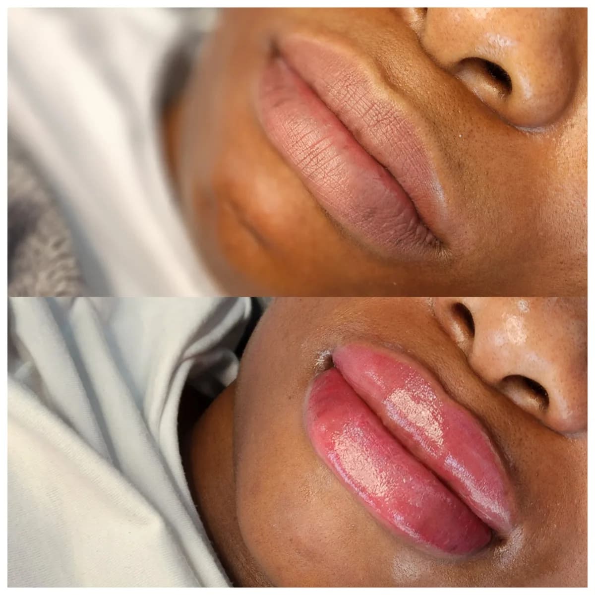 Before and after: Lip hyperpigmentation treatment