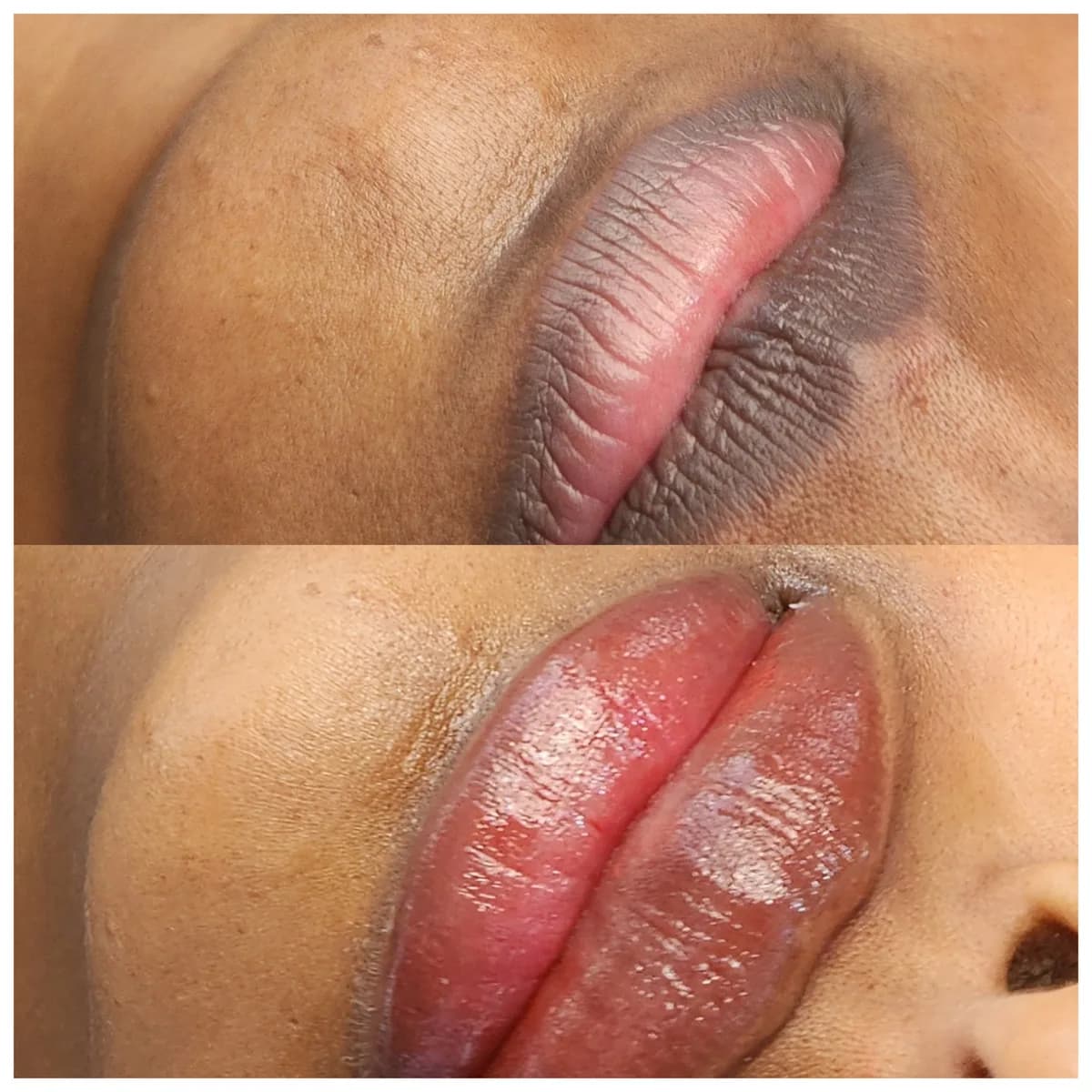 Before and after: Lip hyperpigmentation treatment