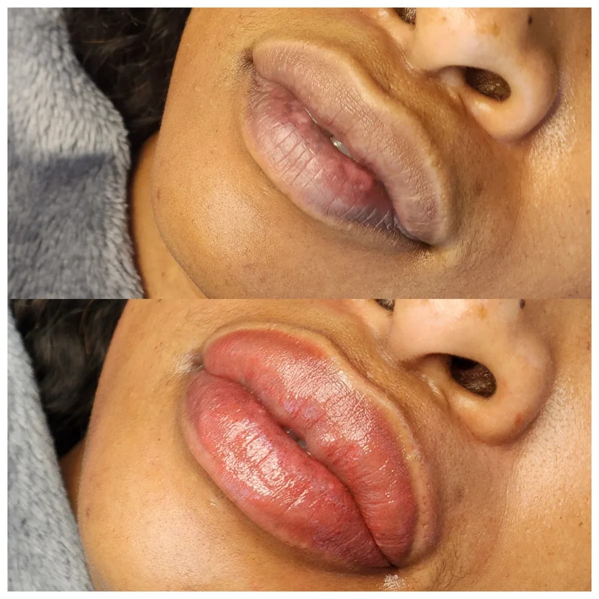 Before and after: Lip hyperpigmentation treatment