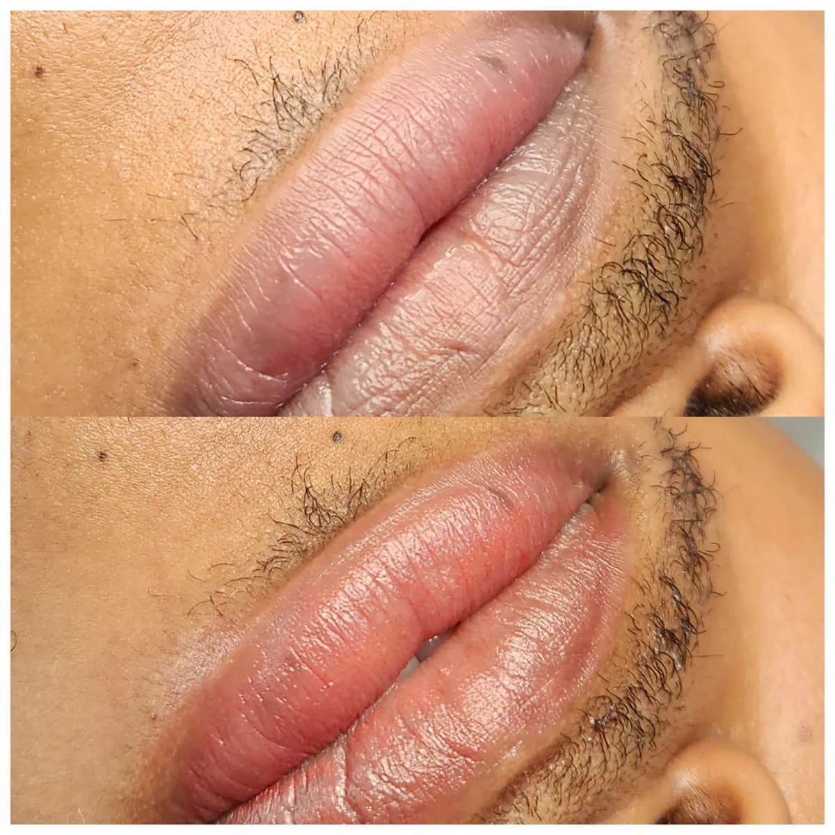 Before and after: Lip hyperpigmentation treatment
