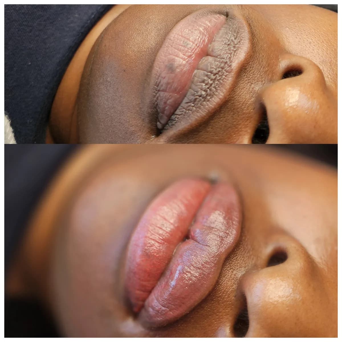 Before and after: Lip hyperpigmentation treatment