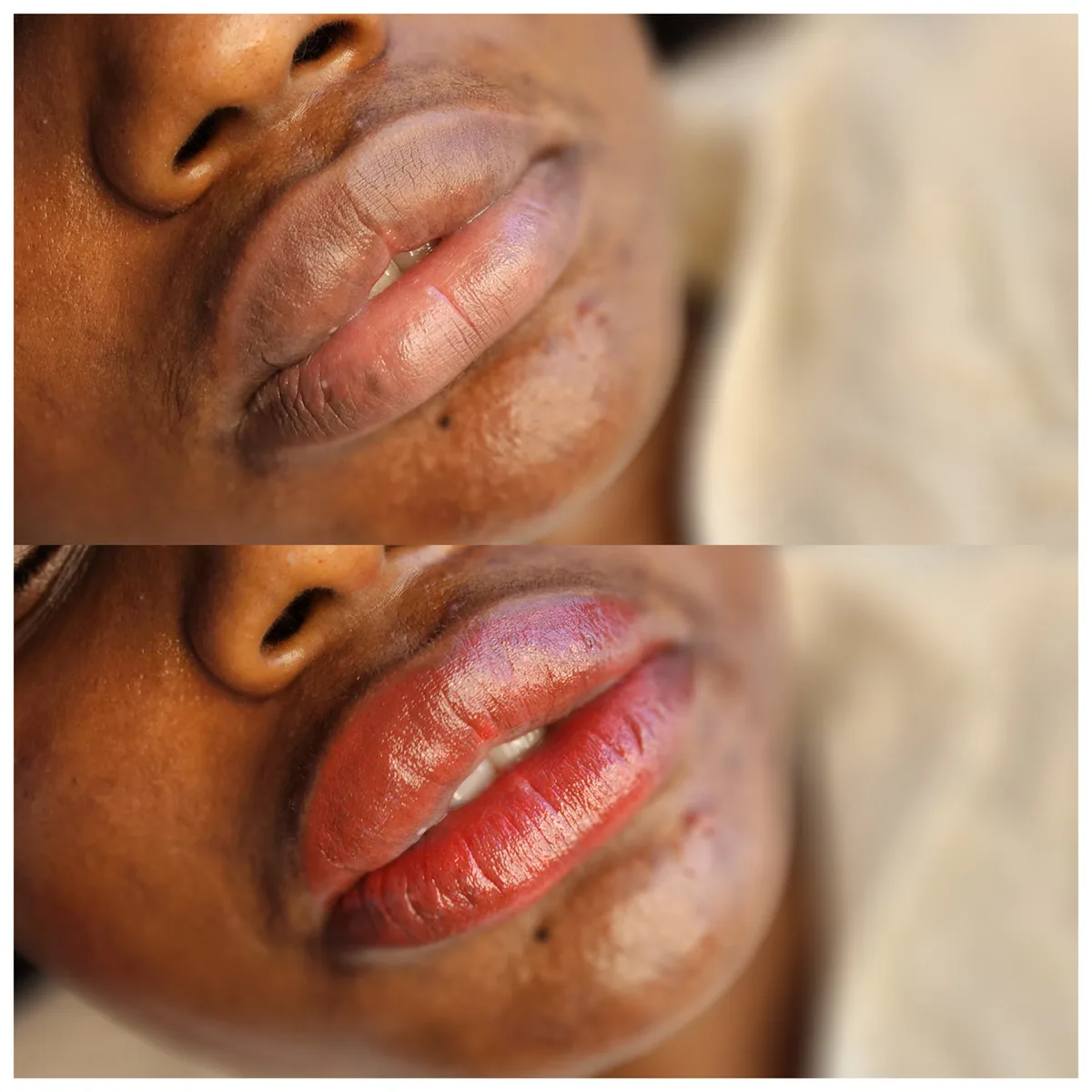 Before and after: Lip hyperpigmentation treatment