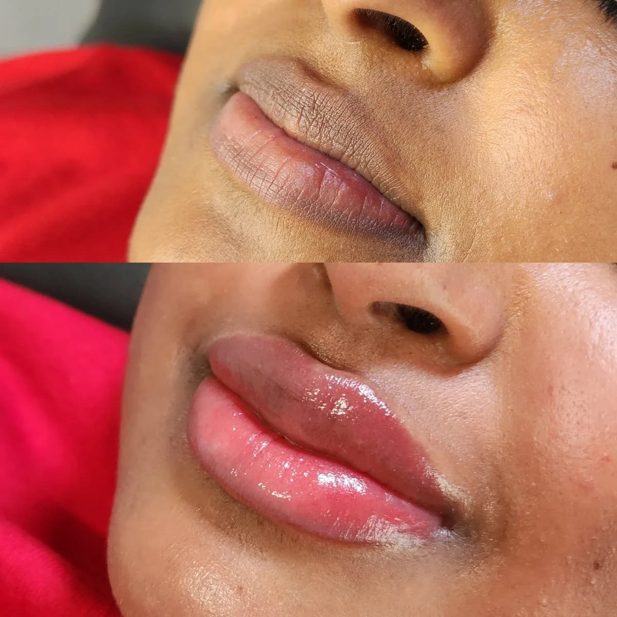 Before and after: Lip hyperpigmentation treatment
