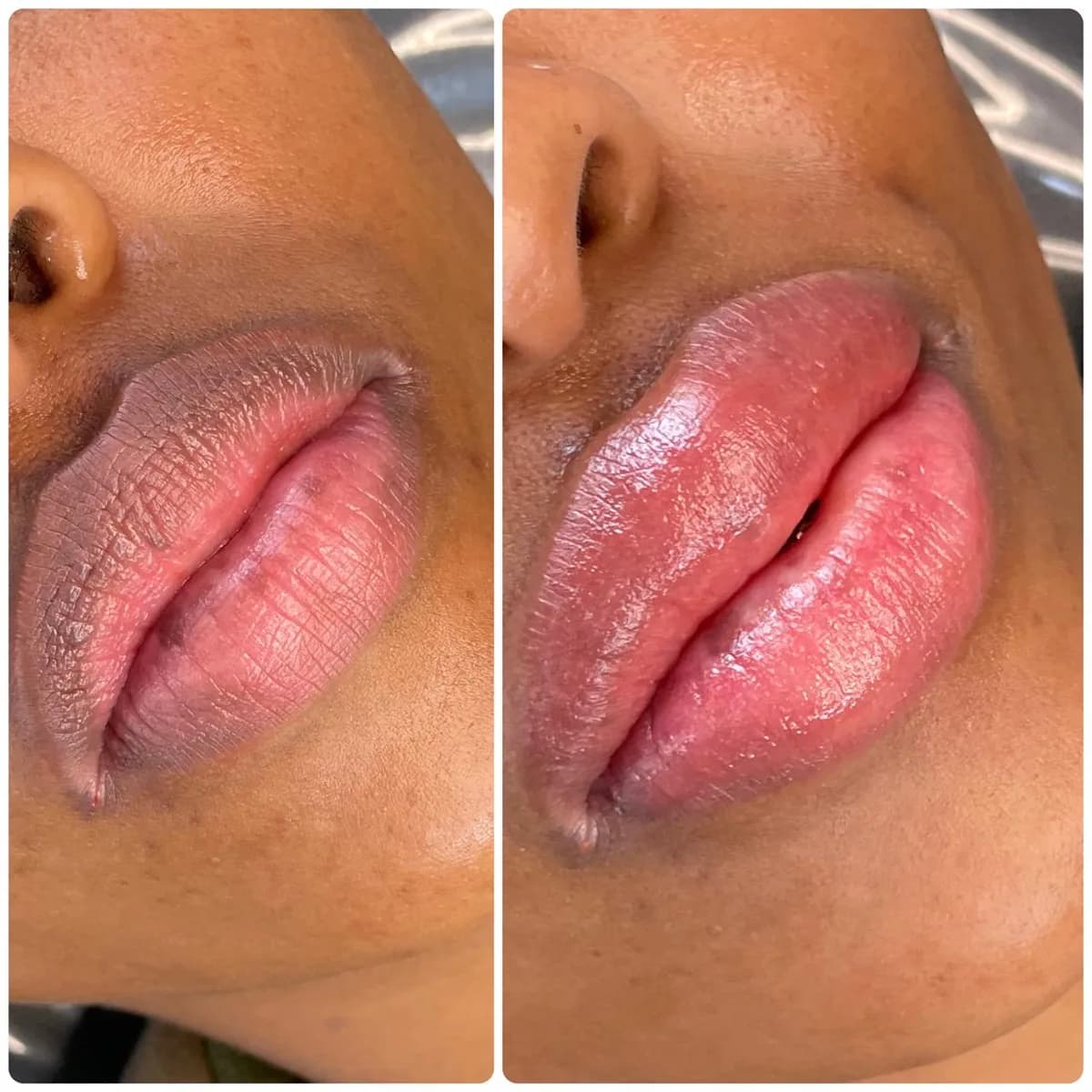 Before and after: Lip hyperpigmentation treatment