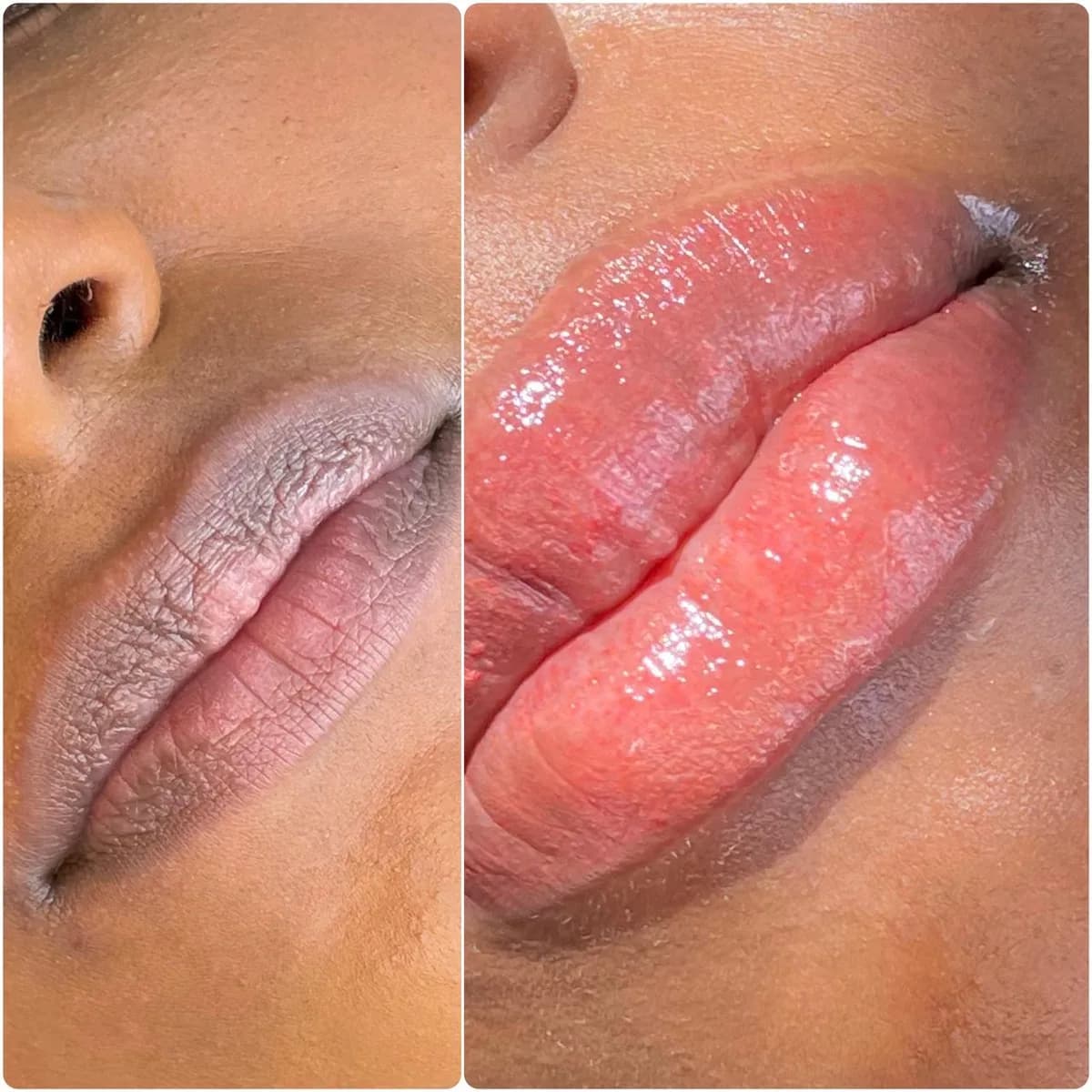 Before and after: Lip hyperpigmentation treatment