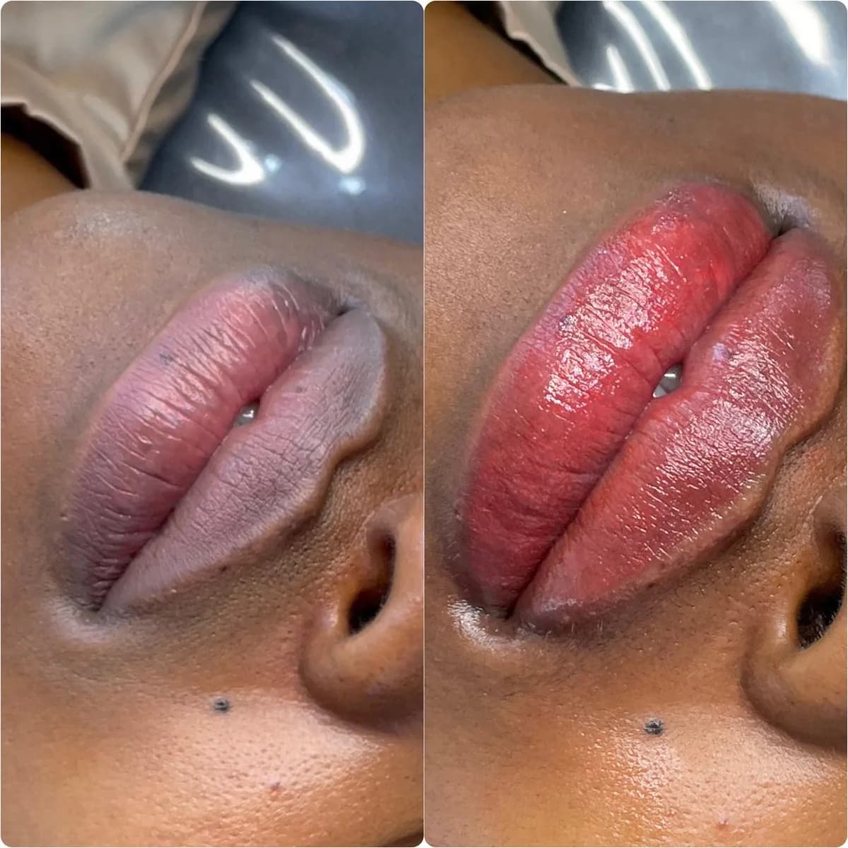 Before and after: Lip hyperpigmentation treatment