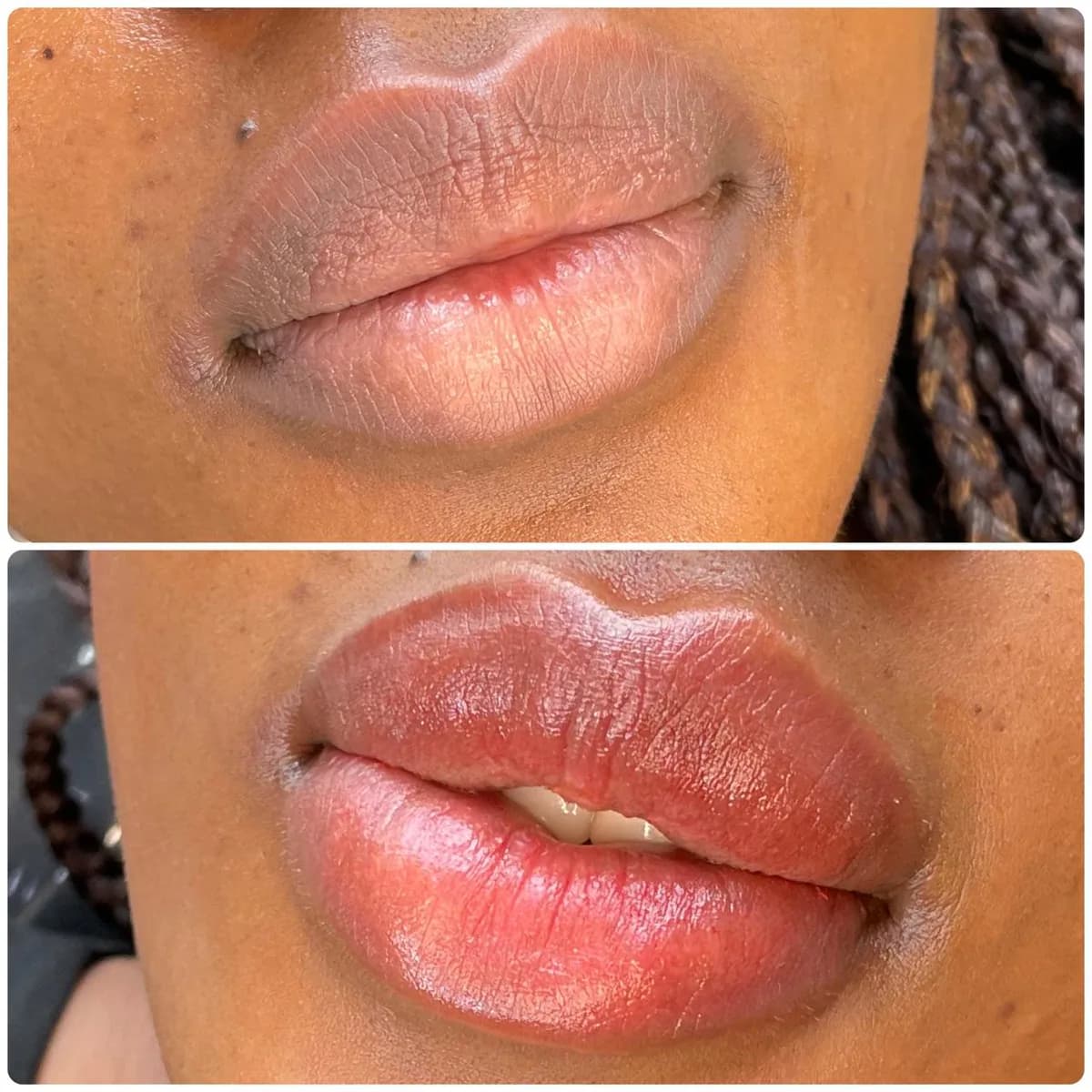Before and after: Lip hyperpigmentation treatment