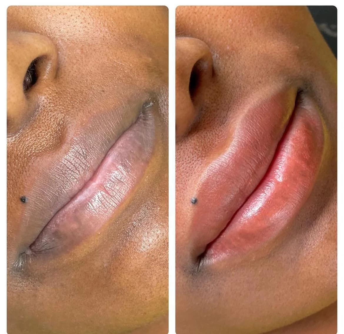 Dark lip neutralisation before and after on melanin-rich skin